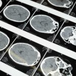 Prelude eClinical system supporting neurological research
