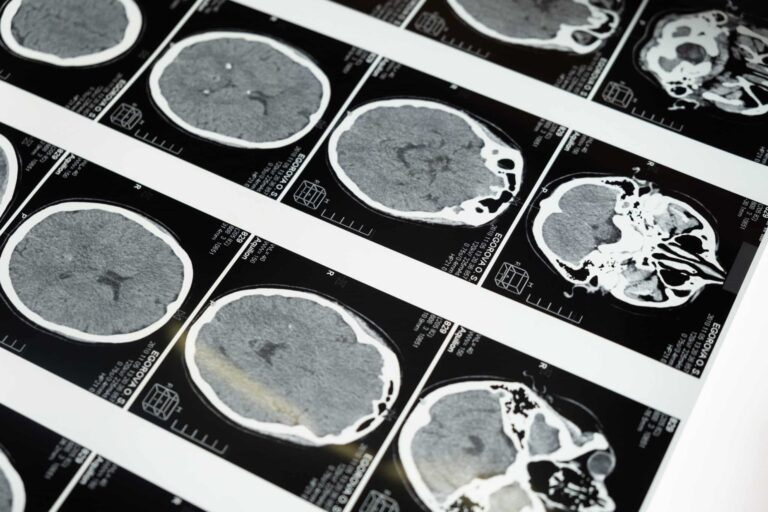 Prelude’s EDC Instrumental in Conducting Head Injury Research in a Multi-Hospital Study